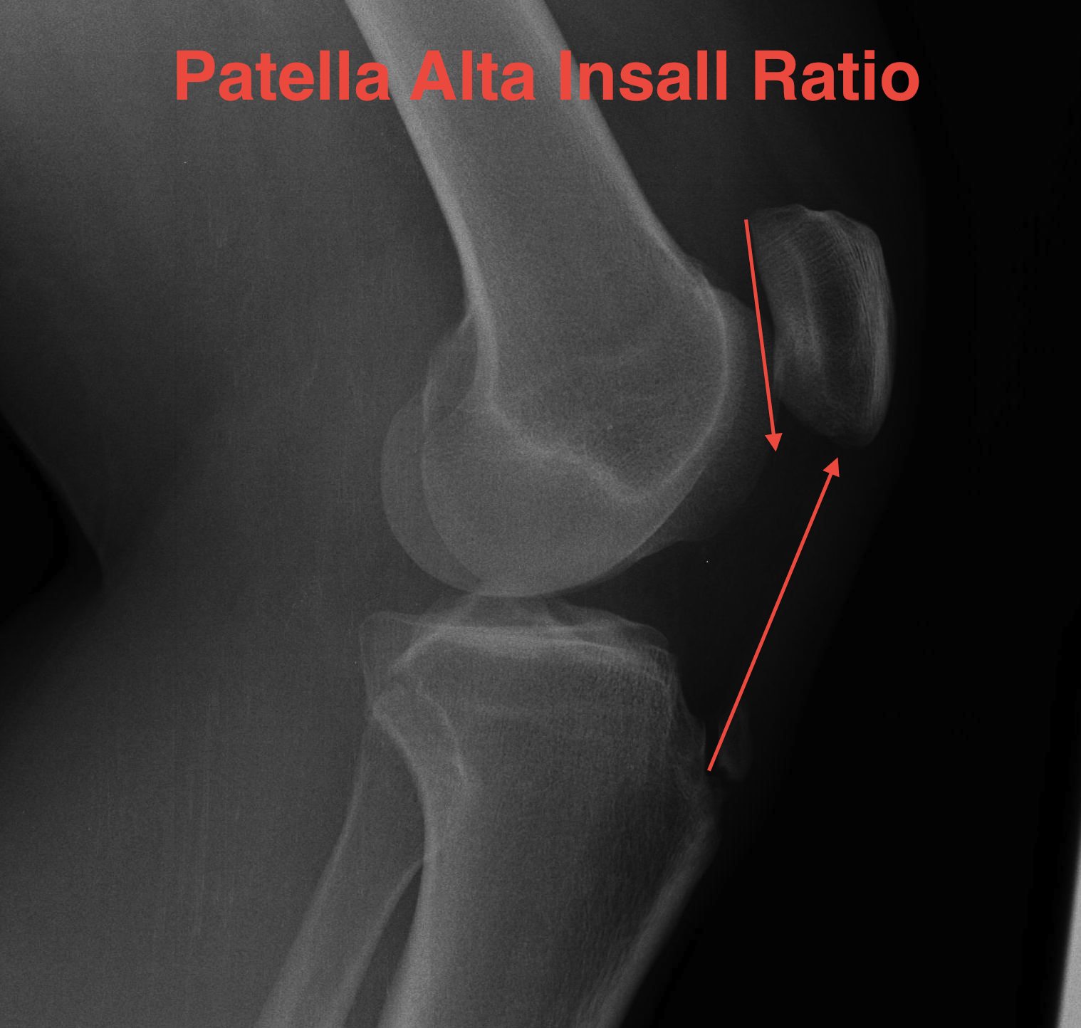 Patella Alta Insall Ratio